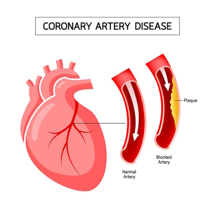 Coronary Artery Disease infographic.