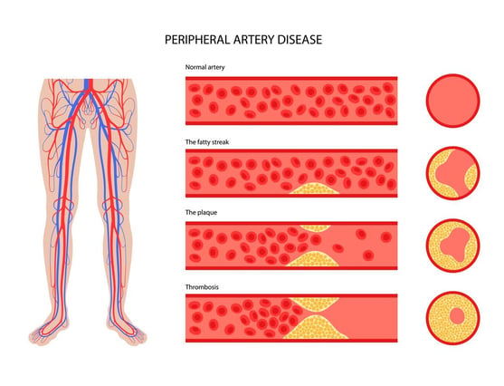 Peripheral Artery Disease infographic.