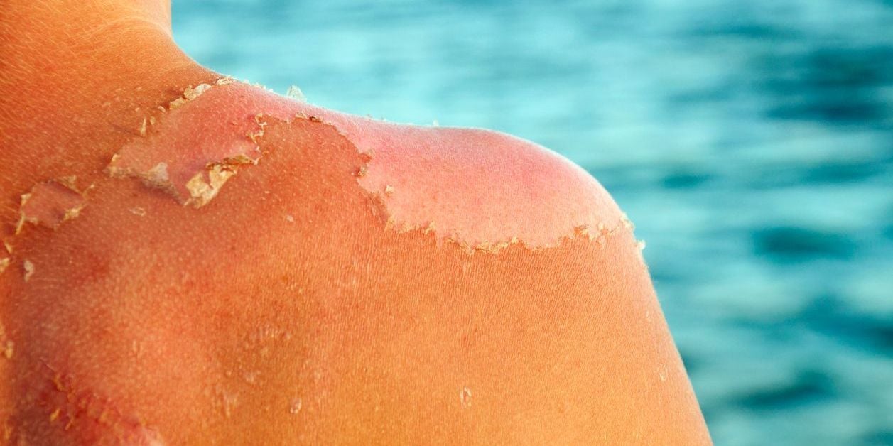 Peeling skin from sunburn