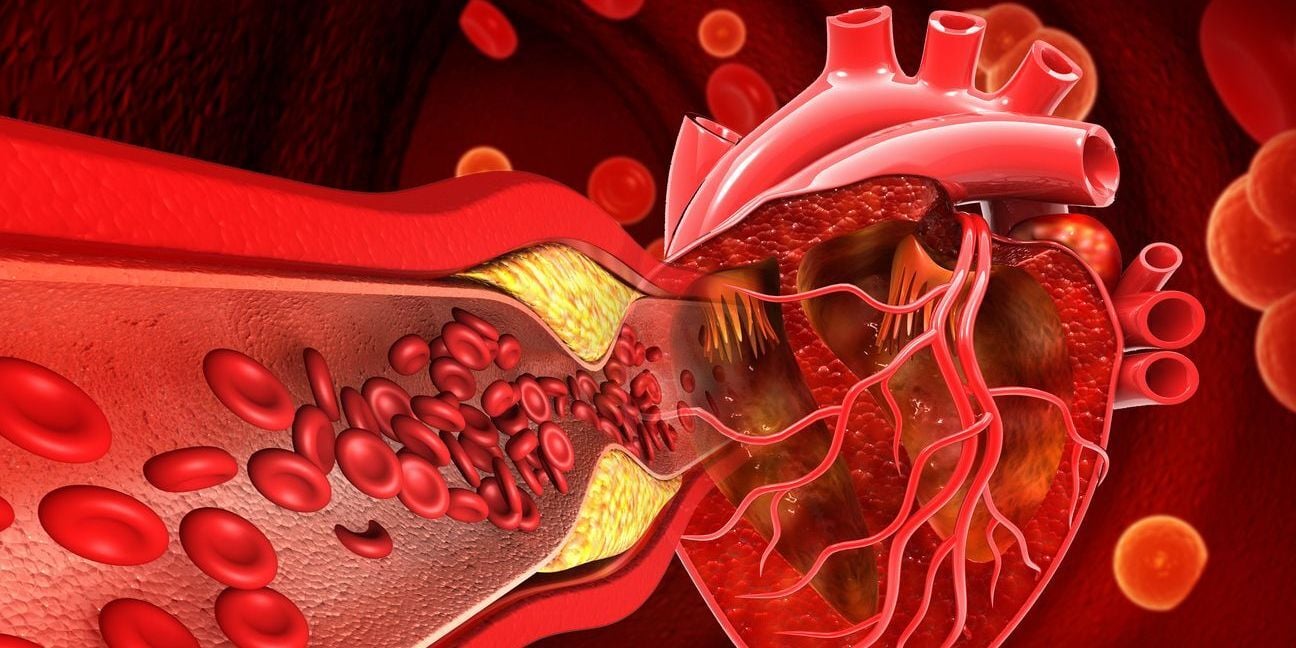 Artery plaque near heart.