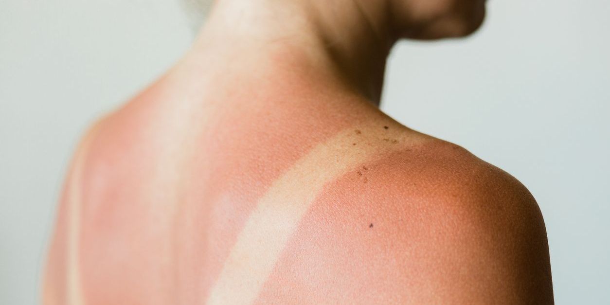 Woman with sunburn